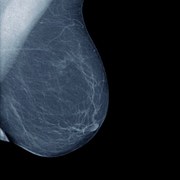Breast Cancer related image